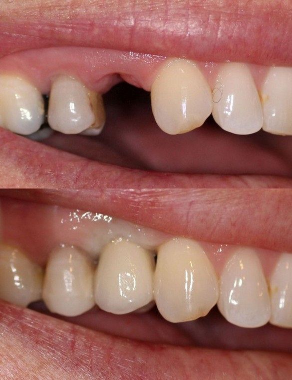 missing tooth restored with dental implant supported porcelain crown