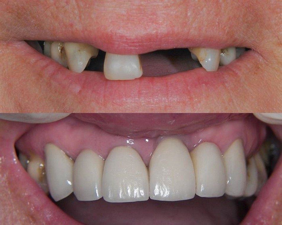 missing teeth restored with dental implant supported porcelain crowns and cantilever bridge