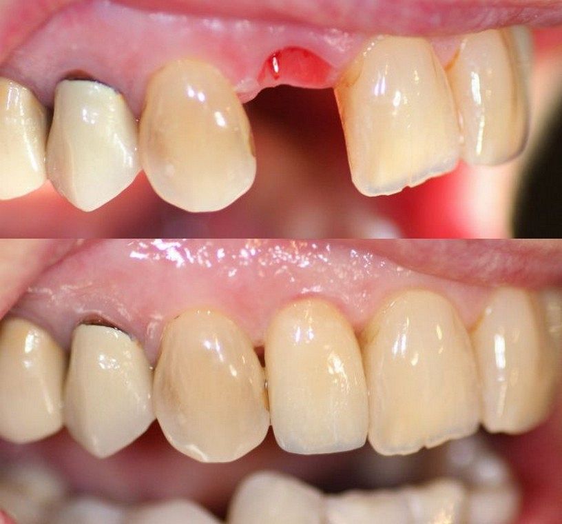 missing tooth restored with dental implant supported porcelain crown