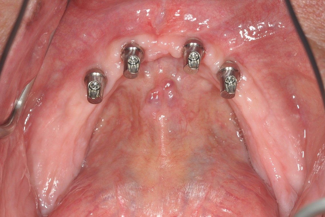 lower jaw no teeth and 4 dental implants