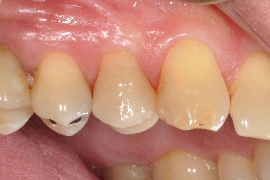 Old Amalgam filling and cusp fracture replaced with emax porcelain overlay crown after