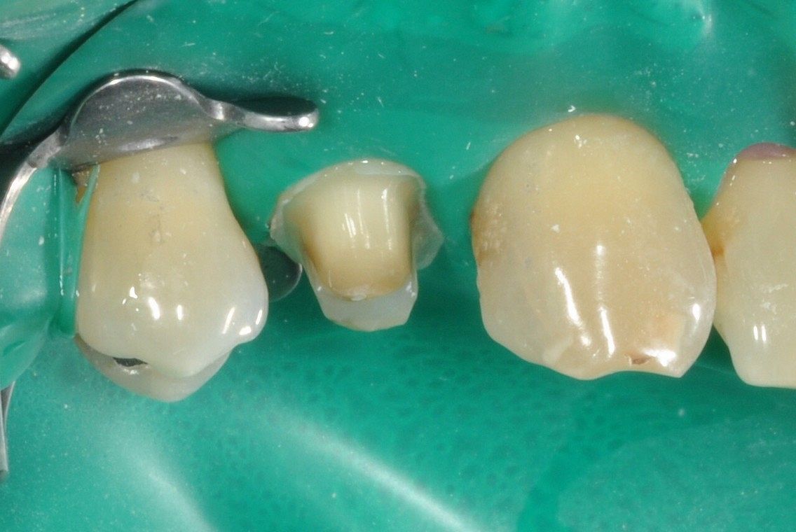 Old Amalgam filling and cusp fracture prepared for overlay Emax crown