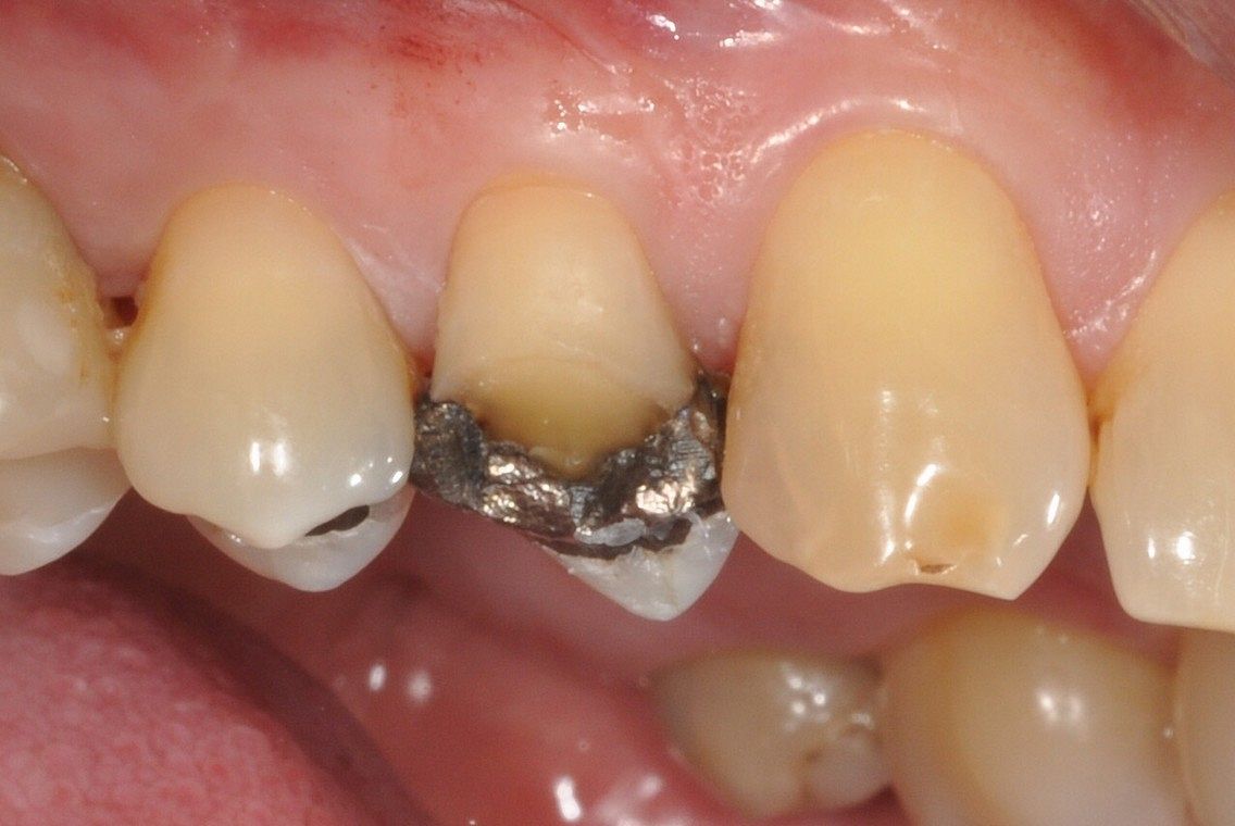 Old Amalgam filling and cusp fracture replaced with emax porcelain overlay crown before