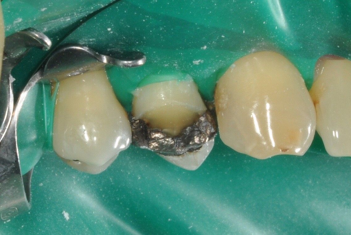 Old Amalgam filling and cusp fracture replaced with emax porcelain overlay crown under rubber dam