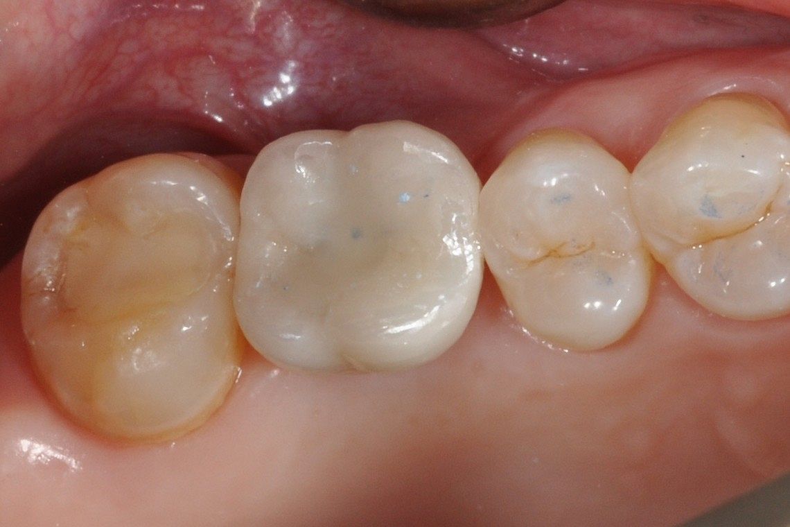 missing tooth restored with dental implant supported porcelain crown after