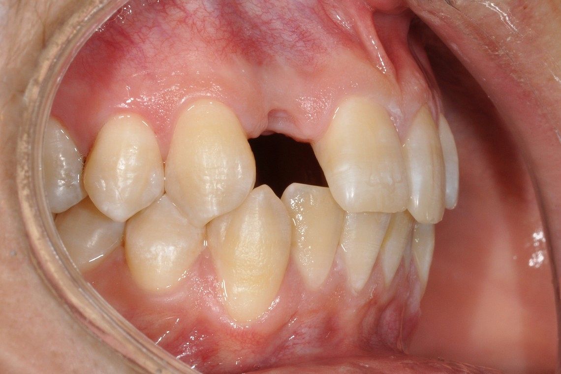 missing tooth restored with dental implant supported porcelain crown before