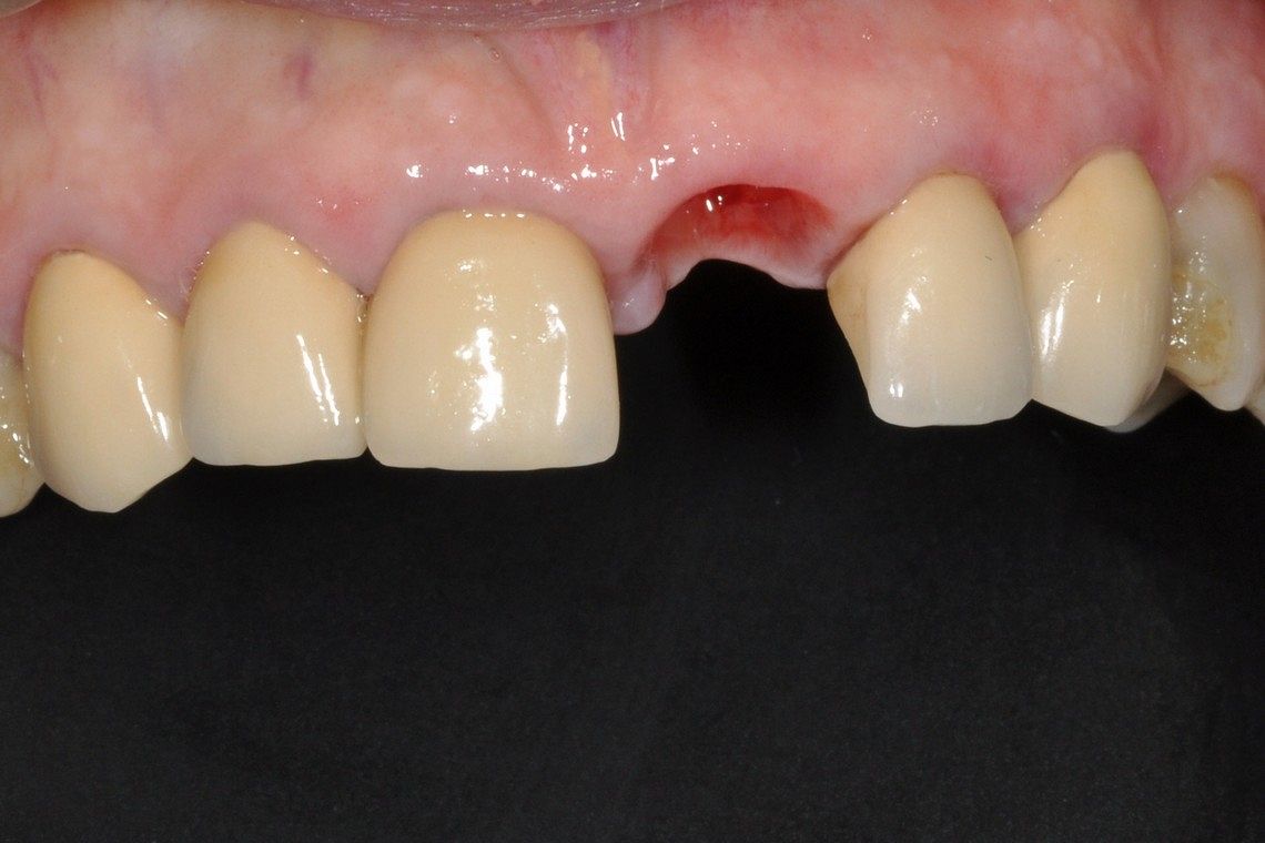 missing tooth restored with dental implant supported porcelain crown before