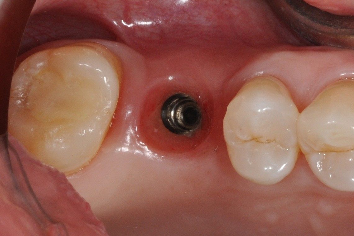 missing tooth restored with dental implant supported porcelain crown before