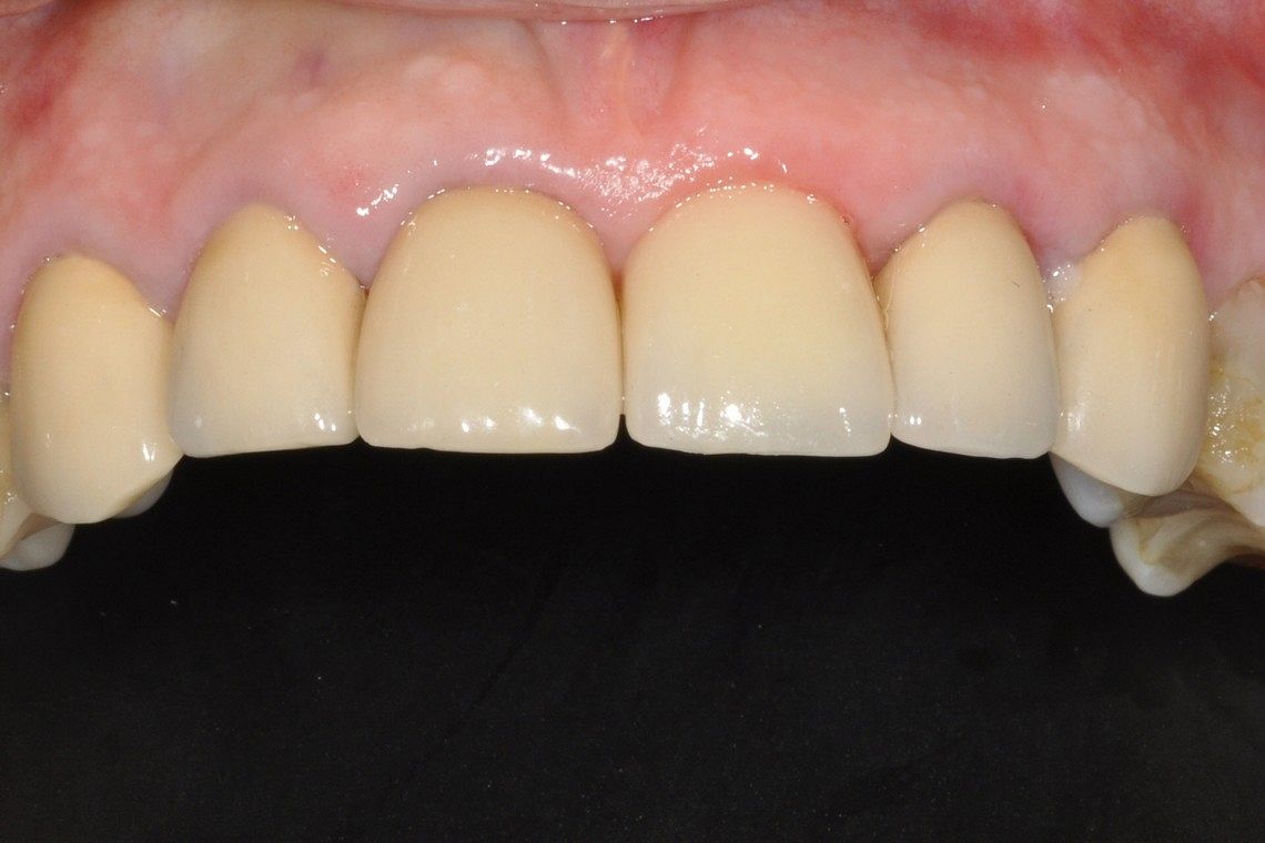 missing tooth restored with dental implant supported porcelain crown after