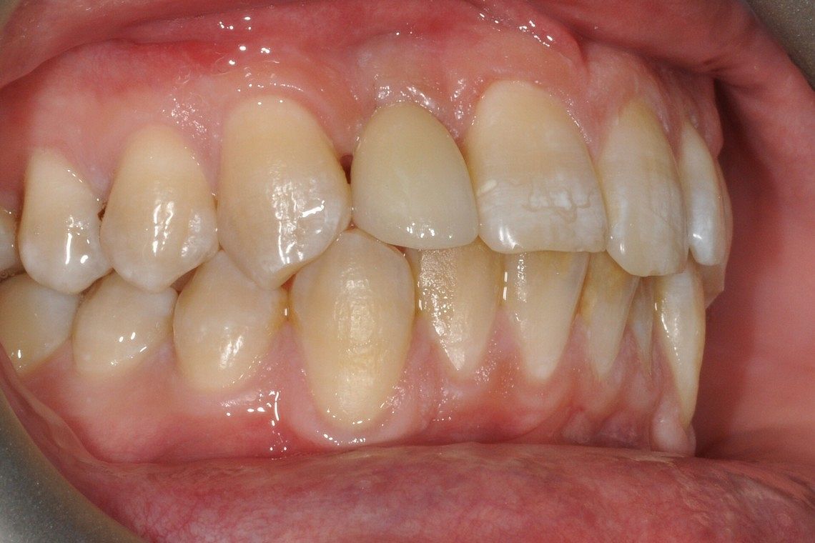 missing tooth restored with dental implant supported porcelain crown after