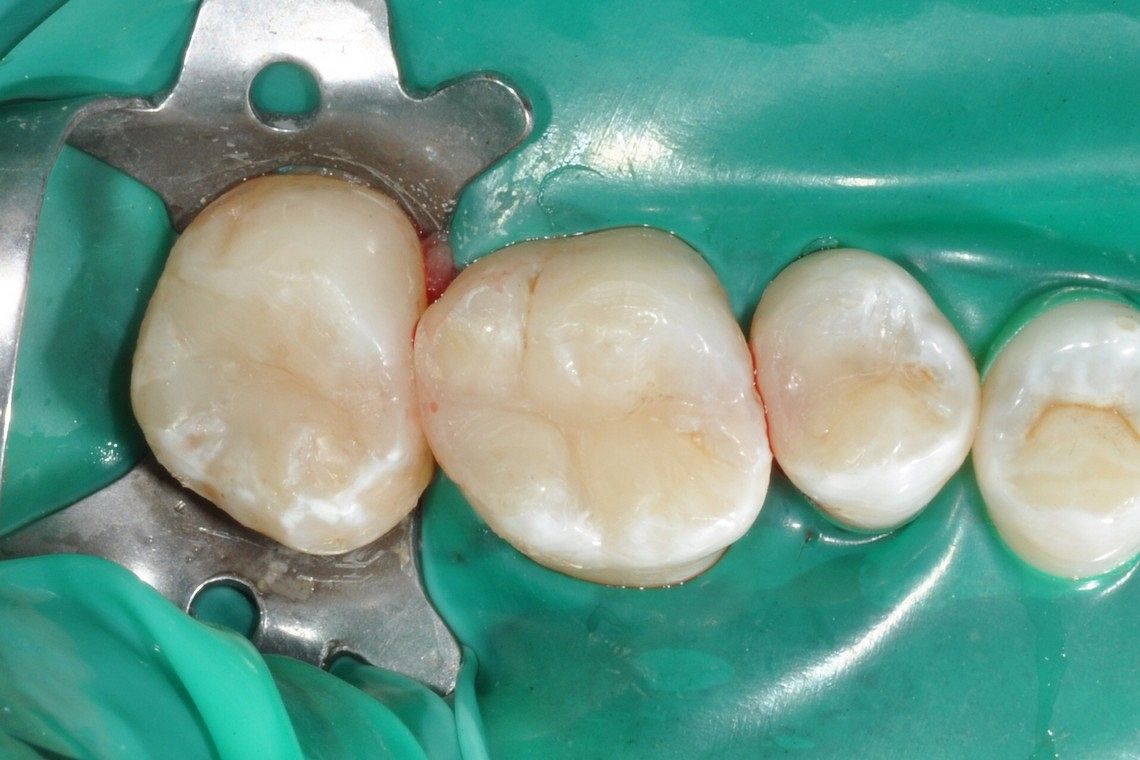 3 old amalgams replaced with white filling using rubber dam - After