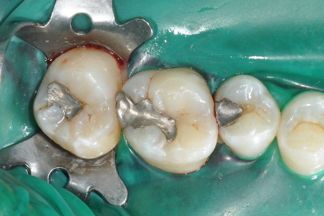 3 old amalgams replaced with white filling using rubber dam - Before