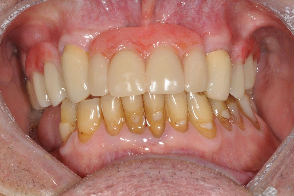 missing teeth restored with chrome cobalt denture and special attachment crowns after