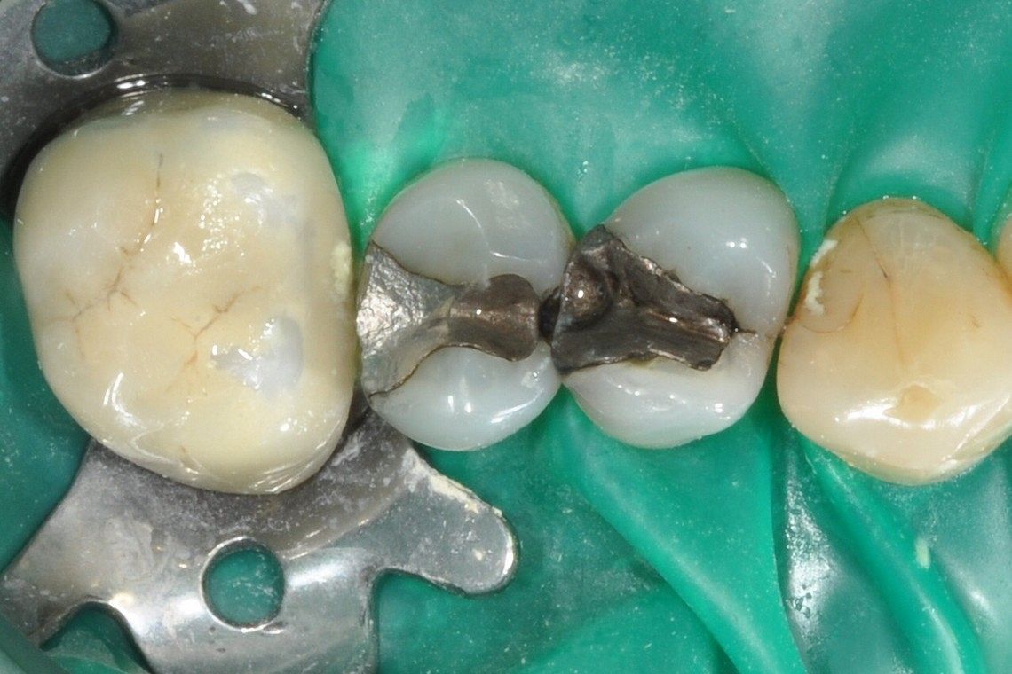 2 old amalgams replaced with white filling using rubber dam - Before