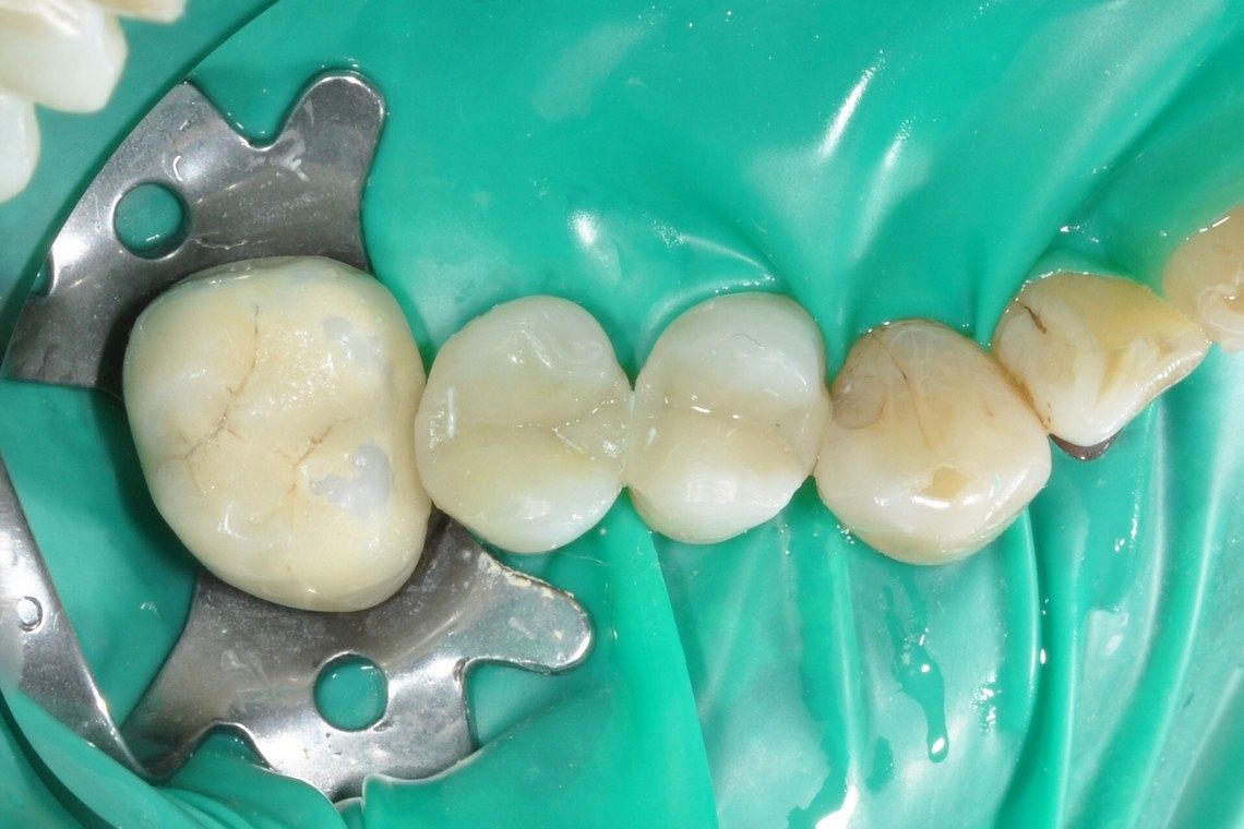 2 old amalgams replaced with white filling using rubber dam - After