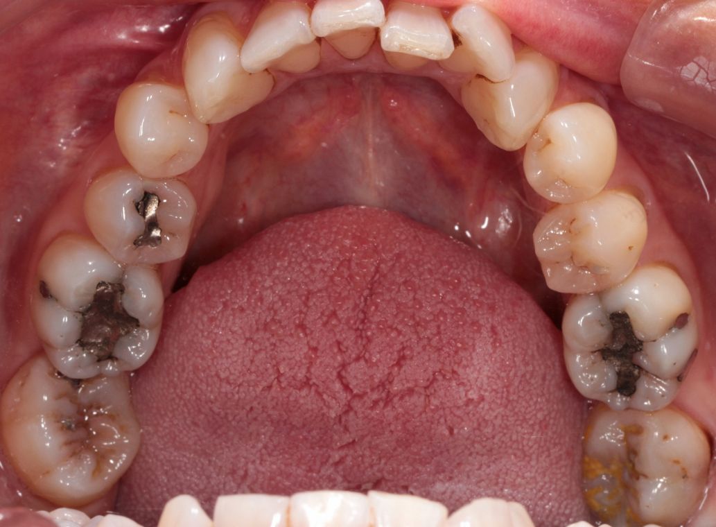 Amalgam fillings replaced with emax overlays and composite resin Before