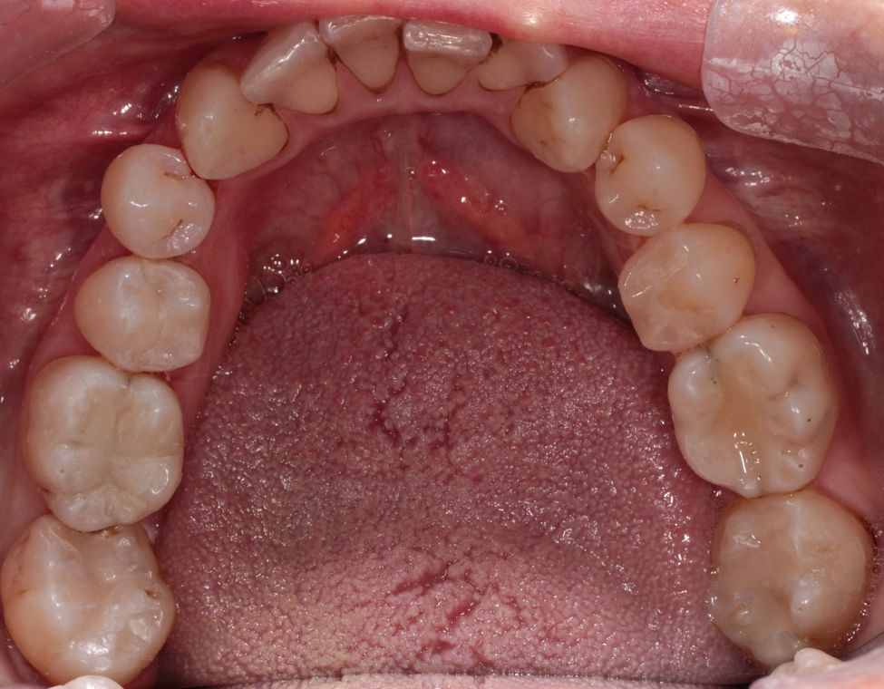 Amalgam fillings replaced with emax overlays and composite resin After