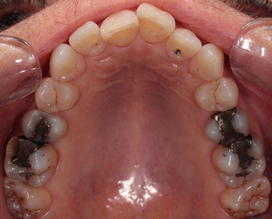 Amalgam fillings replaced with emax overlays and composite resin Before