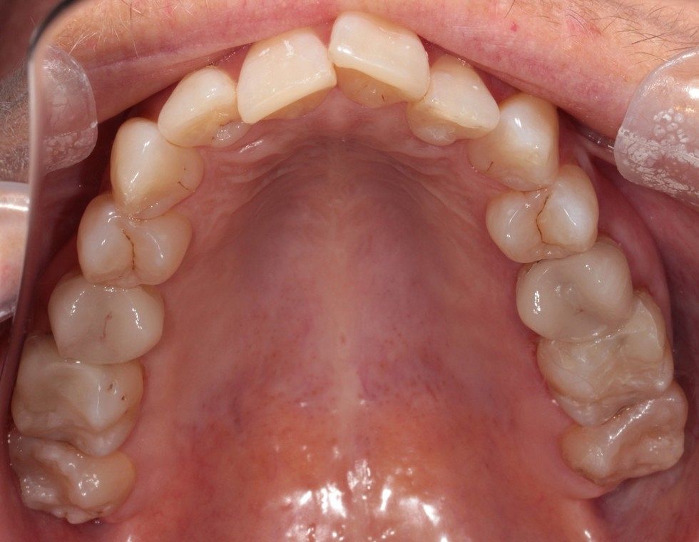 Amalgam fillings replaced with emax overlays and composite resin After