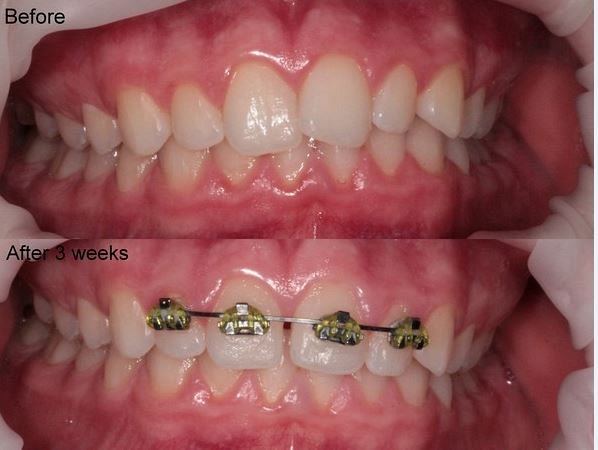 Brace Yourself: A Guide to How Much do Braces Cost in NZ